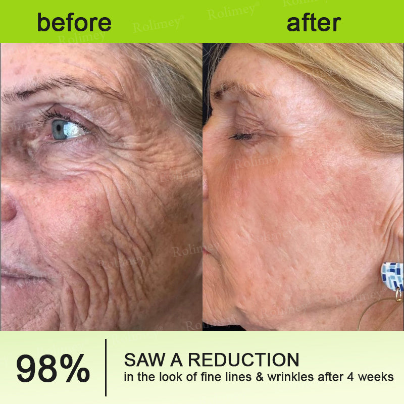 🖤Rolimey® Botox & Vita-A Retinol Shot Wrinkle-Lift Tightening cream - Last Day Promotion 70% OFF