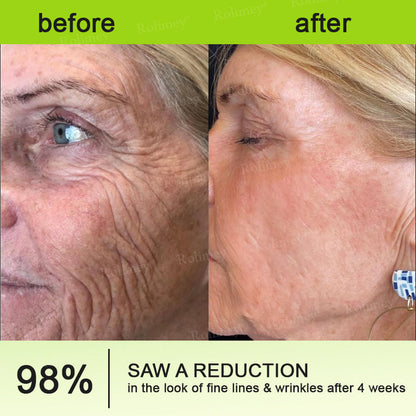 🖤Rolimey® Botox & Vita-A Retinol Shot Wrinkle-Lift Tightening cream - Last Day Promotion 70% OFF