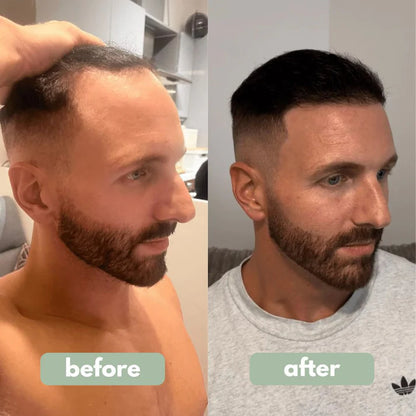 🍇Hair Growth Roll-On Serum – See hair growth in 4 weeks
