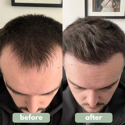 🍇Hair Growth Roll-On Serum – See hair growth in 4 weeks