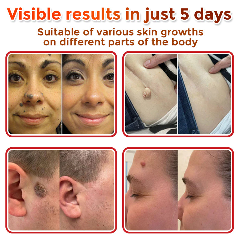 👩‍⚕️ GFOUK® MicroNeedle Botanic Skin Tag Removal Patch