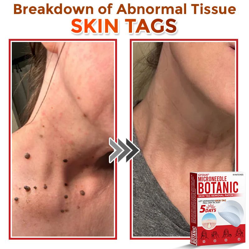 👩‍⚕️ GFOUK® MicroNeedle Botanic Skin Tag Removal Patch