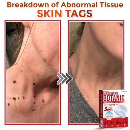 👩‍⚕️ GFOUK® MicroNeedle Botanic Skin Tag Removal Patch