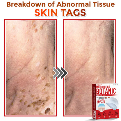 👩‍⚕️ GFOUK® MicroNeedle Botanic Skin Tag Removal Patch